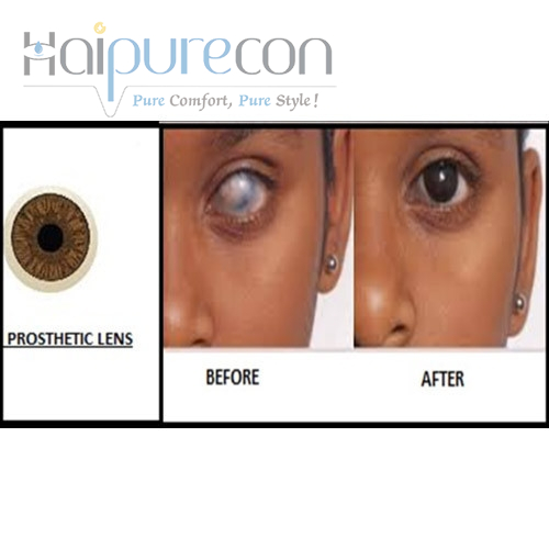 prosthetic lenses